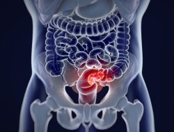 Kanker Usus Intai Generasi Muda, 4 Makanan-Minuman Ini Bisa Jadi Pemicunya
